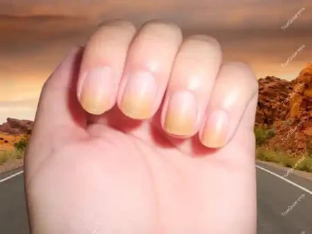 How Diabetes And Yellow Nails Are Associated?